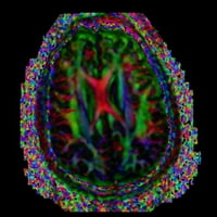 Zidna slika s MRI mozga iz 9197016